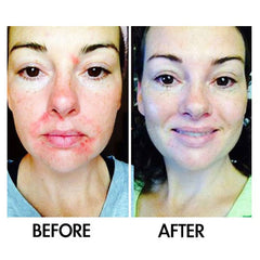 Best Clean Beauty Derm #1 Skincare Skin Perfecting Serum for rosacea and adult acne, 1 fl oz bottle