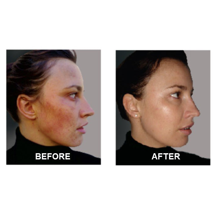 Best Clean Beauty Derm #1 Skin Perfecting Serum for rosacea and adult acne treatment, 1 fl oz bottle.