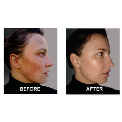 Best Clean Beauty Derm #1 Skin Perfecting Serum for rosacea and adult acne treatment, 1 fl oz bottle.