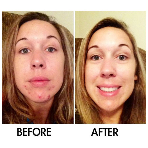 Best Clean Beauty Derm #1 Skin Perfecting Serum for rosacea and adult acne, in a 1 fl oz bottle, with clear serum inside.