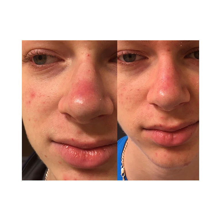SkinSanity® Dual Action Acne Serum by Best Clean Beauty, all-natural acne treatment serum in a 1 fl oz bottle with dropper applicator.