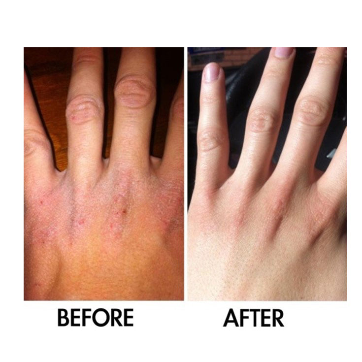 Best Clean Beauty Derm #1 Dry Skin Rescue moisturizer with Vitamin B3, 3.38 oz, featuring a creamy formula for dry skin.